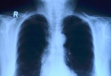 Dostała nowe płuca z koronawirusem