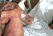 Kanada natychmiast wstrzymuje szczepienia preparatem Astra Zeneca osób w wieku poniżej 55 lat