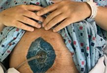 Mężczyzna z Kolumbii Brytyjskiej stracił 2 metry jelita w rezultacie zakrzepicy krwi po wstrzyknięciu szczepionki AstraZeneca