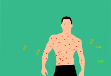 Kanada wprowadza obowiązkową kwarantannę z powodu małpiej ospy