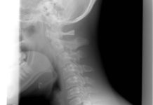 Wysłali go do domu ze złamanym kręgiem szyjnym