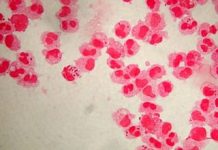 Meningokoki zabijają w Toronto