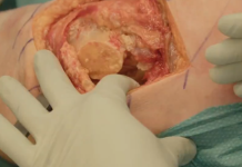 Ontario sfinansuje wymianę stawów biodrowych i kolanowych w prywatnych klinikach