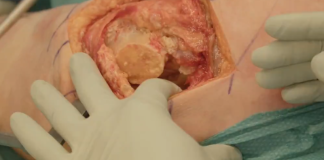 Ontario sfinansuje wymianę stawów biodrowych i kolanowych w prywatnych klinikach