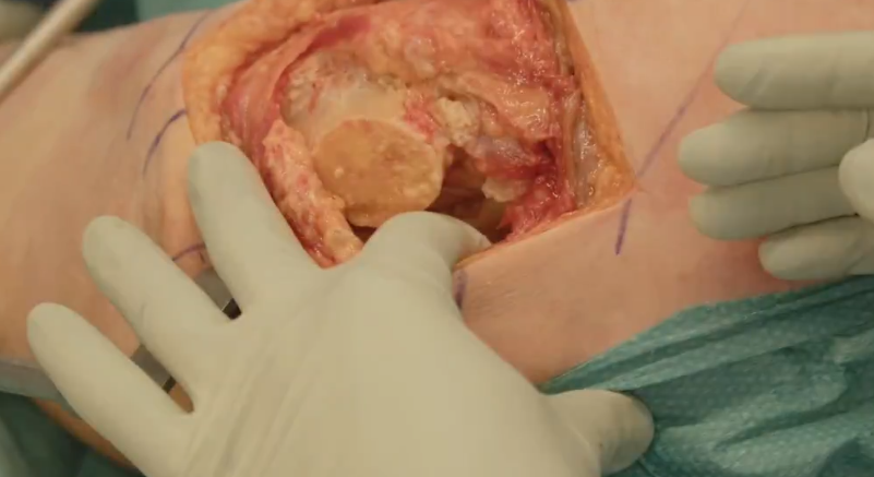 Ontario sfinansuje wymianę stawów biodrowych i kolanowych w prywatnych klinikach