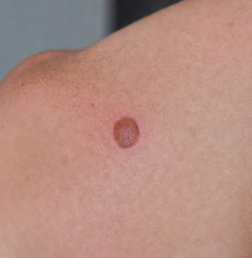 Sprawdź czy nie masz raka skóry